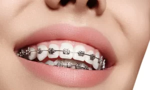 What to Expect with Orthodontic Spacers for Your Child